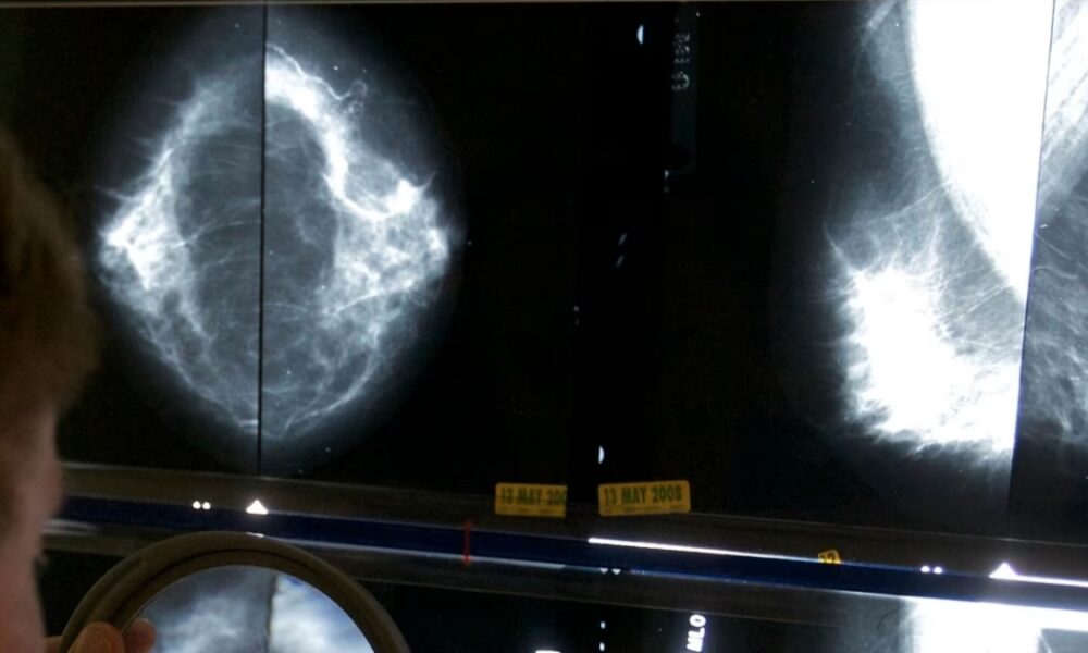 Cáncer de mama figura como “el más diagnosticado entre las mujeres”