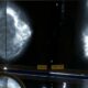 Cáncer de mama figura como “el más diagnosticado entre las mujeres”