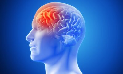 Cada vez más jóvenes sufren ACV precoz en Venezuela